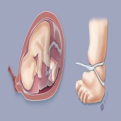 រោគសញ្ញាក្រុម Amniotic band syndrome