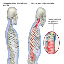 Ankylosing Spondylitis