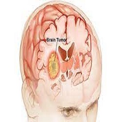 ដុំសាច់ខួរក្បាល Brain Tumor