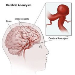 ជំងឺដាច់សរសៃឈាមខួរក្បាល Cerebral Aneurysm