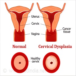 ដាច់សរសៃឈាមខួរក្បាល Cervical Dysplasia