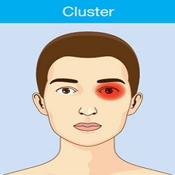 ការឈឺក្បាលពេញទាំងក្បាល Cluster Headaches