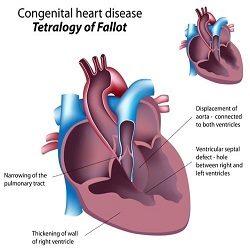 ពិការភាពបេះដូងពីកំណើត Congenital heart defects