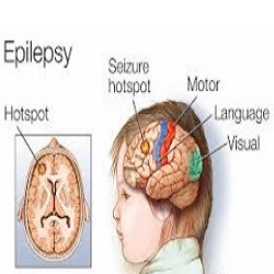 ជំងឺឆ្កួតជ្រូក និងប្រកាច់ Epilepsy and Seizures