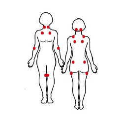 រលាកសរសៃពួរ Fibrositis (Fibromyalgia syndrome)