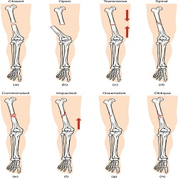 ការបាក់ឆ្អឹង Fractures