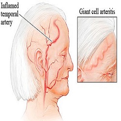 ជំងឺរលាកស្រោមបេះដូង Giant Cell Arteritis