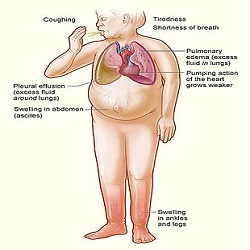 ជំងឺខ្សោយបេះដូង Heart failure