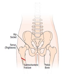 ការបាក់ឆ្អឹងត្រគាក Hip Fracture