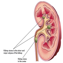 គ្រួសក្នុងតម្រងនោម Kidney stones