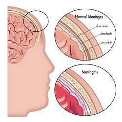 ជំងឺរលាកស្រោមខួរ Meningitis