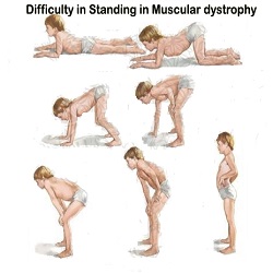 ជំងឺសាច់ដុំ Muscular Dystrophy