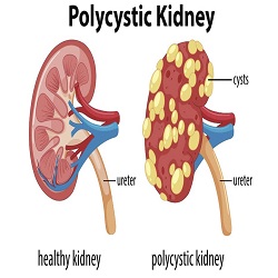 ជំងឺរលាកតំរងនោម Polycystic kidney disease