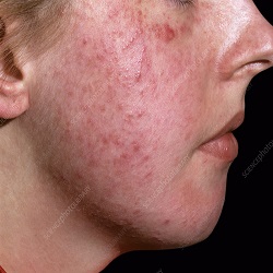 រ៉ូសាសេ Rosacea