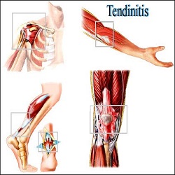 រលាកសរសៃពួរ Tendinitis