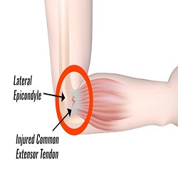 ឈឺឆ្អឹងកែងដៃ Tennis Elbow