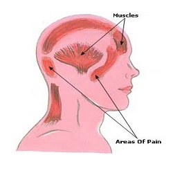 ភាពតានតឹងឈឺក្បាល Tension Headaches