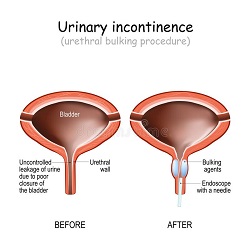 នោមទាស់ Urinary Incontinence