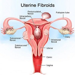 Uterine Fibroids ខាងក្រៅ Uterine Fibroids External