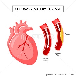 ជំងឺសរសៃឈាមបេះដូង coronary artery disease