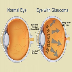 ជំងឺដក់ទឹកក្នុងភ្នែក Glaucoma