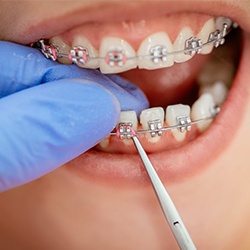 ការព្យាបាលធ្មេញ Orthodontic  Treatment (Alignment of teeth),Metal,Ceramic,Invisible Aligne