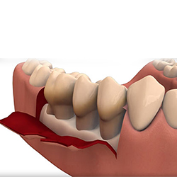 ការវះកាត់ប្រហោងធ្មេញ Periodontal Flap Surgery