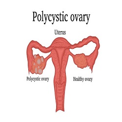 រោគសញ្ញា Polycystic ovary syndrome