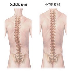 ជំងឺ Scoliosis 